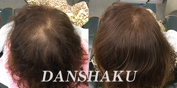 女性増毛 Before After 大阪エクステ増毛 ヘアーズ男爵